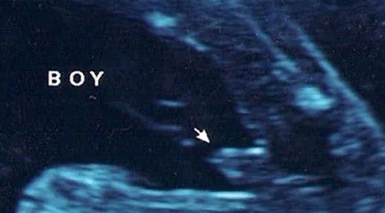 胎心看男女_胎心看男女准吗_太准了!胎心看男女