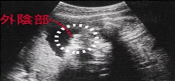 太准了!胎心看男女_胎心看男女准吗_胎心看男女